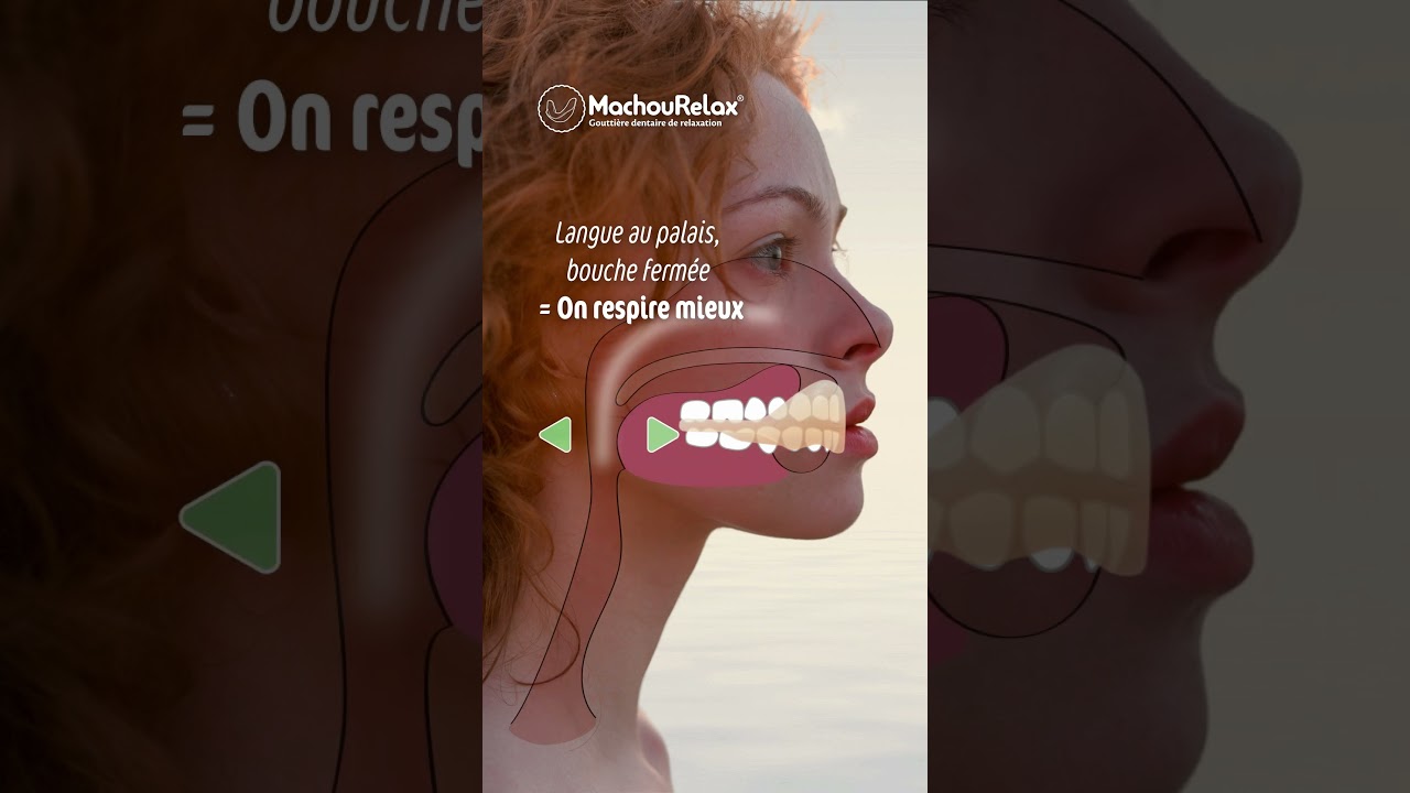 MachouRelax : gouttière dentaire pour adultes.