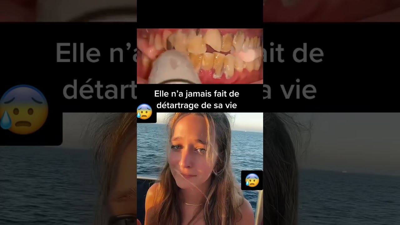 Elle n’a jamais fait de détartrage !!  #shorts